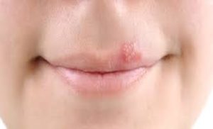 Lancing Dental Care Cold Sore Policy Due to the risk of cross infection to our patients and staff members we will no longer treat patients with active cold sores unless treatment is urgent. If you are currently suffering with a cold sore and not in need of urgent care, we kindly ask that you re-arrange your appointment. Cold sores are contagious from the moment you first feel tingling to when the lesion has completely healed. A healed cold sore is one that is no longer visible. We thank you for your understanding in this matter.
